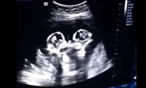 బాబోయ్ తల్లిగర్భంలోనే ఇలా కిక్‌బాక్సింగ్‌ ఆడుకుంటున్నారేంటి..?(వీడియో)