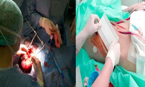 విశాఖ కిడ్నీ రాకెట్ కేసు: త్రిసభ్య కమిటీ విచారణలో ఆసక్తికర విషయాలు