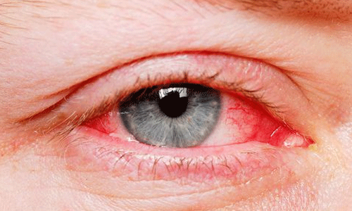 ఆ సమయంలో కళ్లు ఎర్రగా ఎందుకు మారతాయి..?