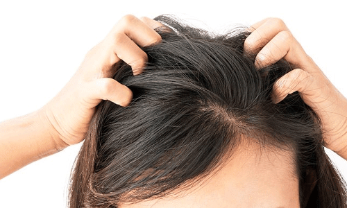 తలలో పేలు ఎలా వస్తాయంటే..!