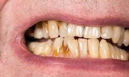 చిగుళ్ల వ్యాధితో చిక్కులే...