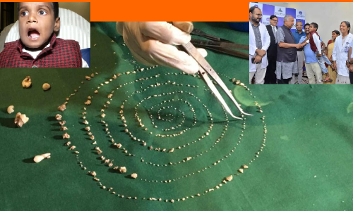 ఏడేళ్ళ బుడతడికి 526 పళ్ళు.. ప్రపంచంలోనే తొలిసారి..