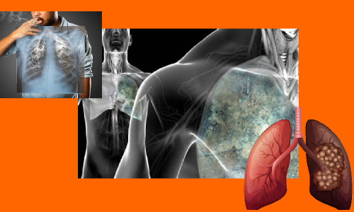 లంగ్ క్యాన్సర్..చప్పుడులేకుండా చుట్టేస్తుంది!