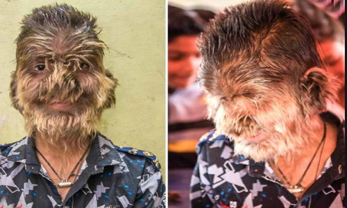 హెయిర్ ఫాల్ ను తగ్గించడం కోసం ఆ మందు వాడారు.. చివరకు తోడేలు అయ్యారు..