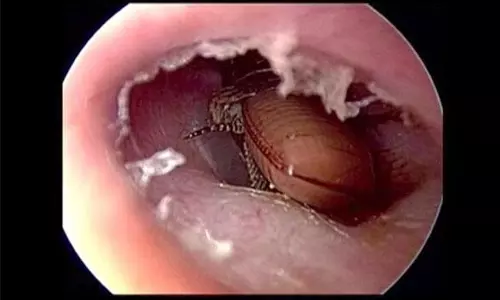 చెవు నొప్పితో వచ్చిన యువకుడిని పరీక్షించిన వైద్యుడు ఆశ్చర్యపోయాడు