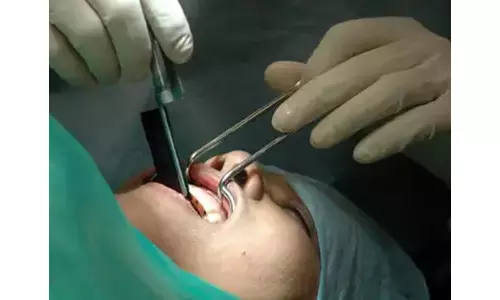 ముక్కులో పెరిగిన దంతం...