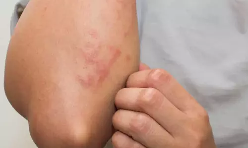 Skin Rashes: స్కిన్ అలర్జీతో అప్రమత్తం
