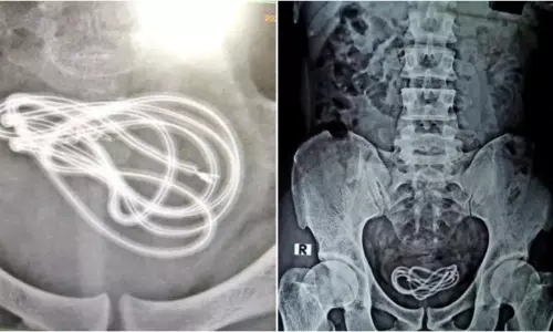 మూత్రాశయం నుండి మొబైల్ ఛార్జర్ తొలగింపు..