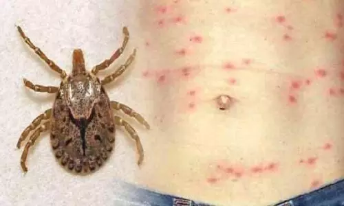 విశాఖ వాసులను భయపెడుతున్న స్క్రబ్ టైఫస్