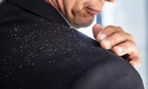 22 Easy Home Remedies for Dandruff Control - Causes & Prevention