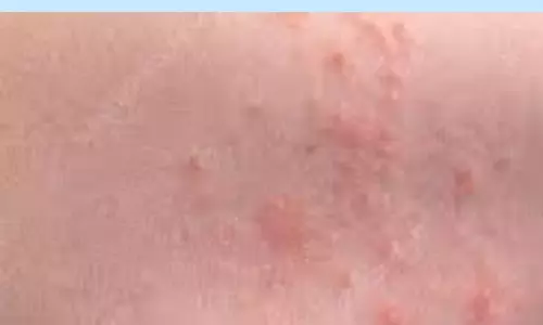 Tips To Heat Rashes Problems