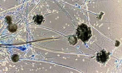 Telangana Govt Takes Key Decision On Black Fungus Cases Telangana Govt Takes Key Decision On Black Fungus Cases