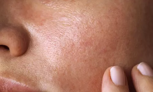 Home Remedies and Skin Care Routine for Oil Skin Naturally Home Remedies and Skin Care Routine for Oil Skin Naturally