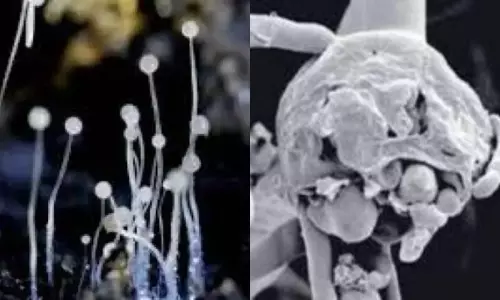 Black Fungus And White Fungus Infected in one Person