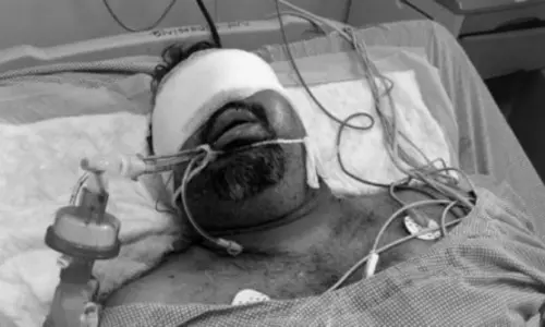 Health Condition of Kathi Mahesh Critical After Road Accident