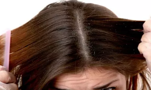 Trying to clear Dandruff here is some tips for reduce dandruff instantly Trying to clear Dandruff here is some tips for reduce dandruff instantly