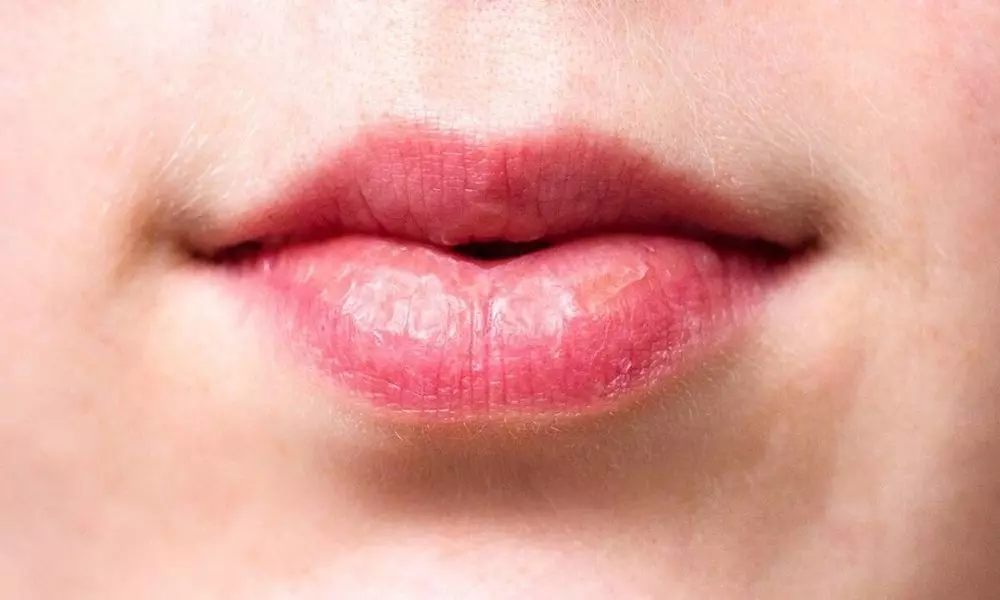 Are the Lips Cracking in the Winter do it Simply