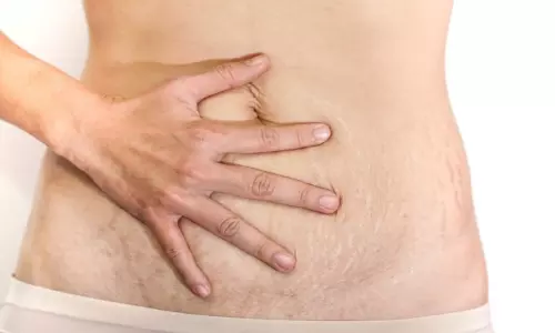 Does the Skin get Wrinkled After Delivery try These Remedies Does the Skin get Wrinkled After Delivery try These Remedies