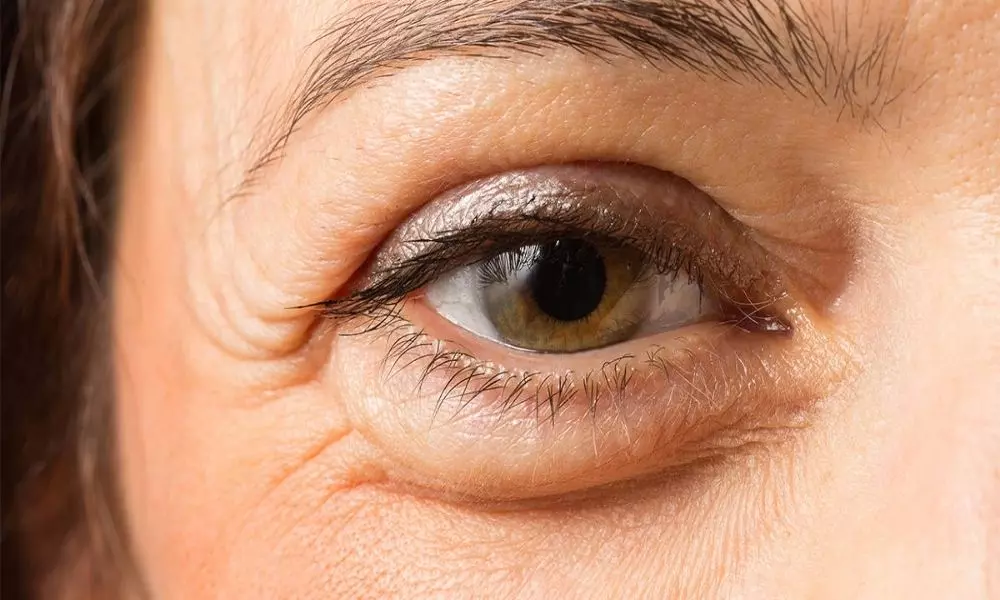 Are Your Eyes Swollen When you Wake up in the Morning It may be a Symptom of This Disease