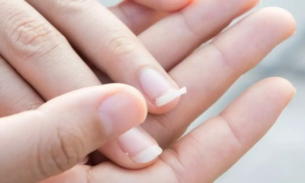 If the Hand Nails are Growing are they Breaking a Sign of These Diseases | Tips for Healthy Nails