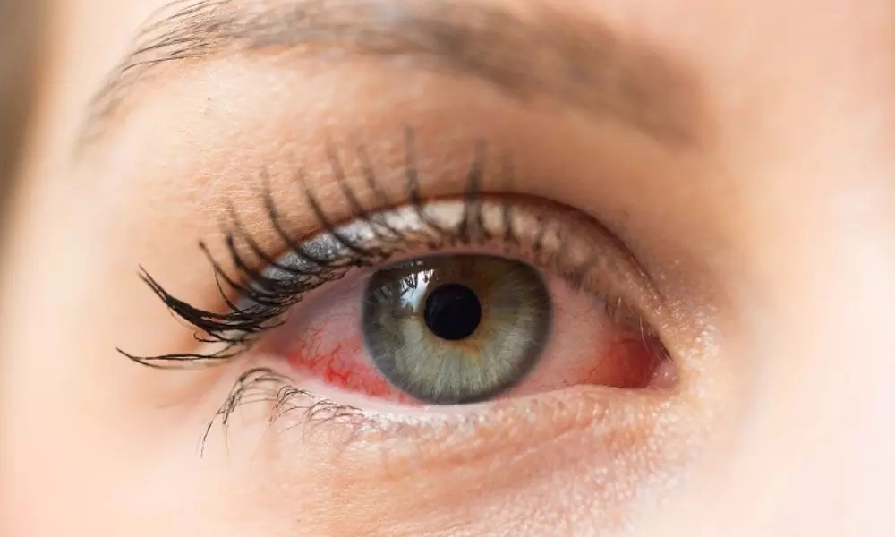 These Home Remedies to Get Rid of Eye Strain‎ Try These Simple Tips For Your Eye Health | Eye Care Tips