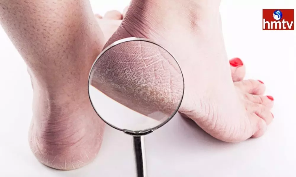 Those who Suffer From Cracked Feet Should Follow These Tips