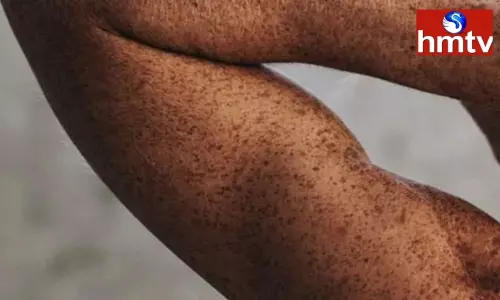 Symptoms and treatment of ichthyosis vulgaris