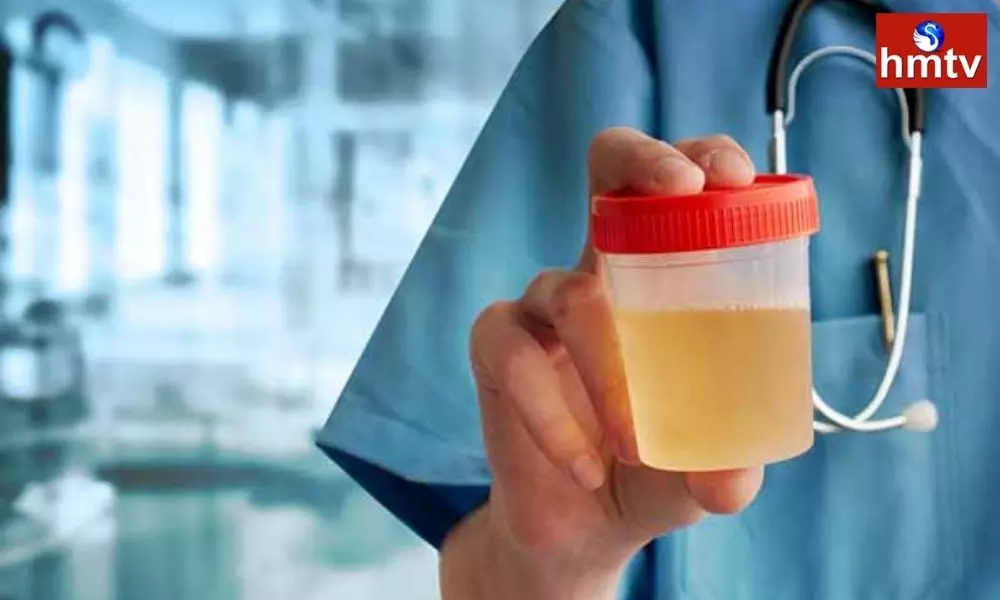 Health News be Careful if There is a Difference in the Color of the Urine