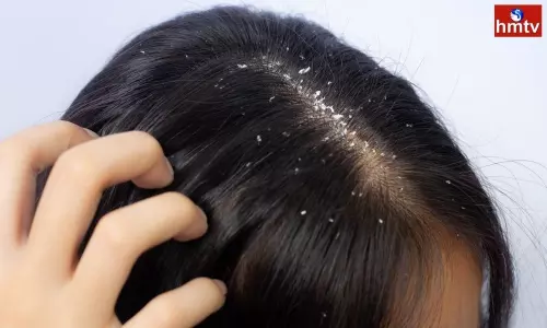 Suffering From Dandruff Problems Follow These Methods | Dandruff Home Remedies Suffering From Dandruff Problems Follow These Methods | Dandruff Home Remedies