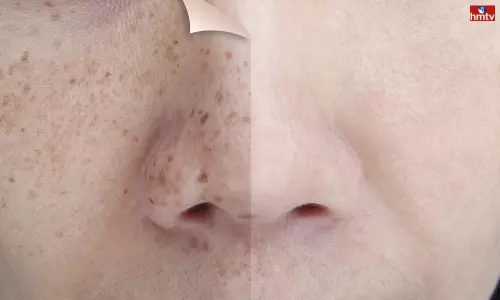 Remove Scars on face with 4 items in the kitchen | Beauty Care Tips Telugu Remove Scars on face with 4 items in the kitchen | Beauty Care Tips Telugu