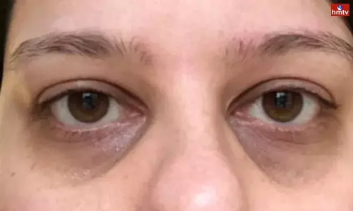 Sunken Eyes Causes Treatments Find out the Reasons | Eye Care Tips