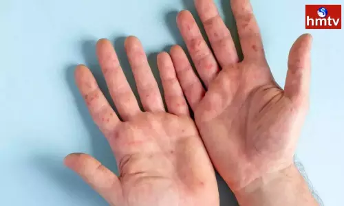 Tomato Flu Infecting Young Children In Kerala