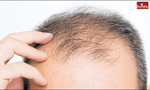 Calling a Man Bald Head is Sexual Harassment Calling a Man Bald Head is Sexual Harassment