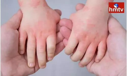 Tomato Flu Outbreak in Kerala, Tamil Nadu