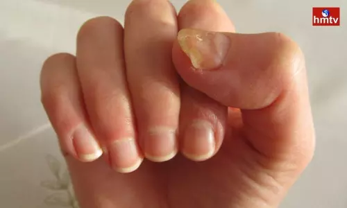 Have Your Nails Turned Yellow be Careful Have Your Nails Turned Yellow be Careful