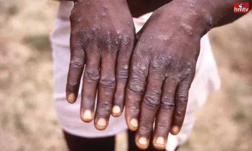 America Confirms 1st Case Of Monkeypox | Telugu Online News