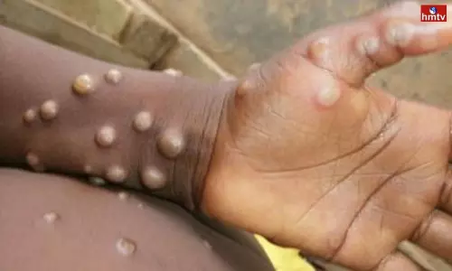 Monkeypox Cases Increasing Worldwide WHO Alert to all Countries | Live News