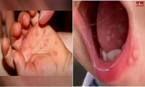 Tomato Flu Tension in India 36 Cases Breakout in Odisha | Tomato Flu Live Updates