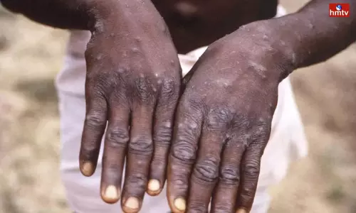 Monkey Pox Spread In 58 Countries