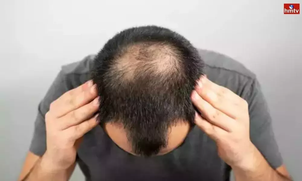It is Better to Stay Away From These Ingredients to Prevent Baldness