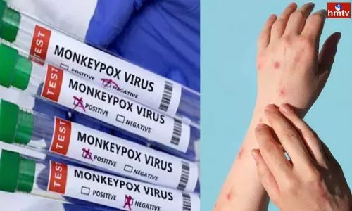 Monkeypox in Telangana