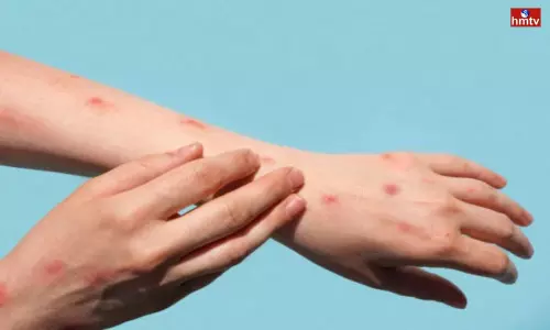 First Suspected Monkeypox Case in AP