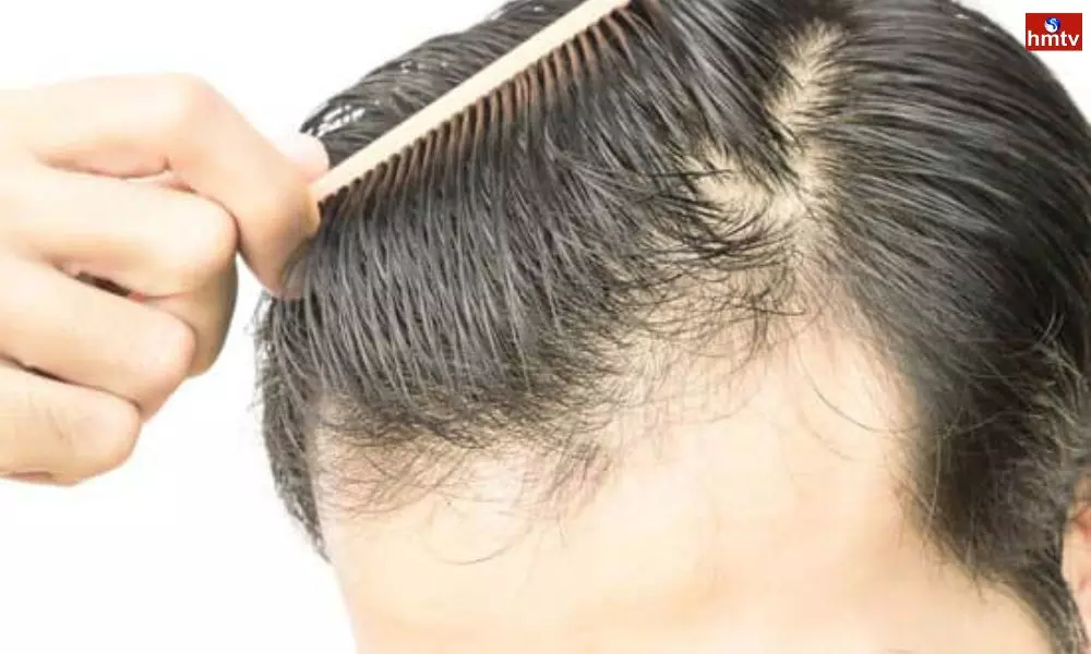 Men Should Follow These Simple Steps to Prevent Hair Fall