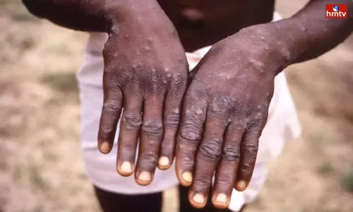 Monkeypox in Visakhapatnam | AP News Monkeypox in Visakhapatnam | AP News