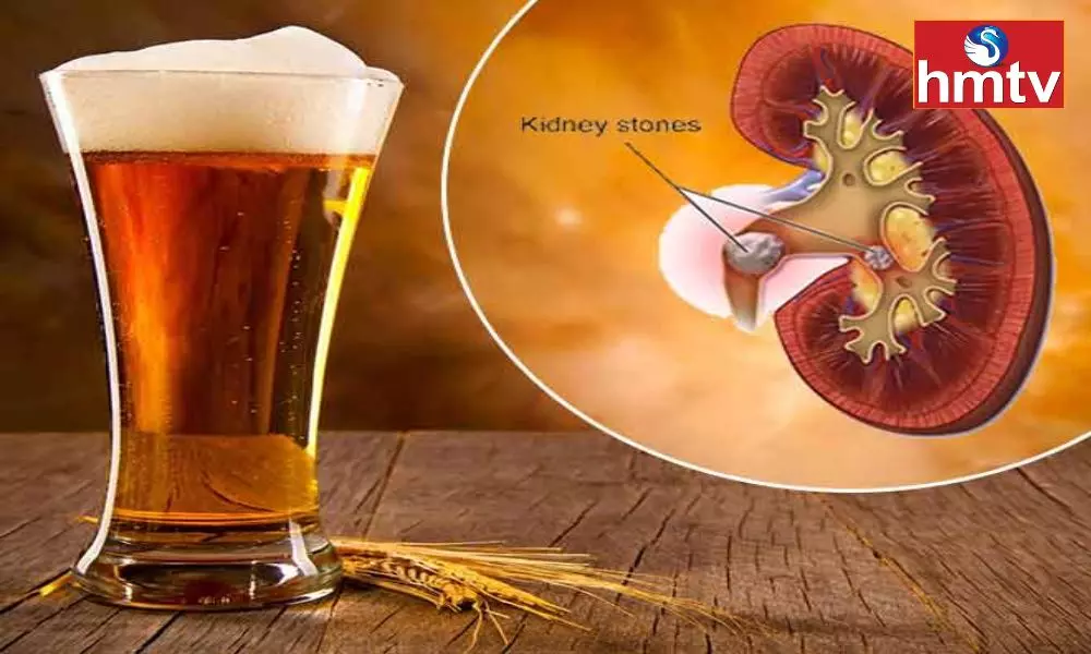 Does Drinking Beer Dissolve Kidney Stones Know the Real Thing