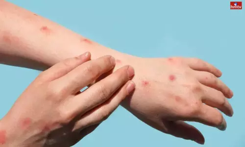 Another Monkeypox Case Has been Reported in Delhi