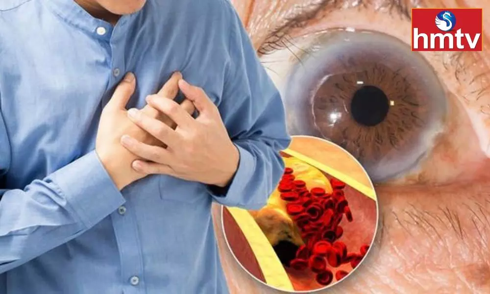 Do not Ignore Cholesterol Note These Symptoms