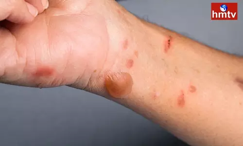 Tomato flu Cases on the Rise in India