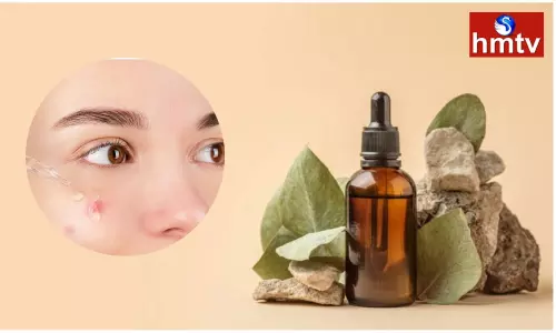 Tea Tree Oil is Best for Skin Care Blackheads and Pimples Disappear Immediately After Using it Tea Tree Oil is Best for Skin Care Blackheads and Pimples Disappear Immediately After Using it