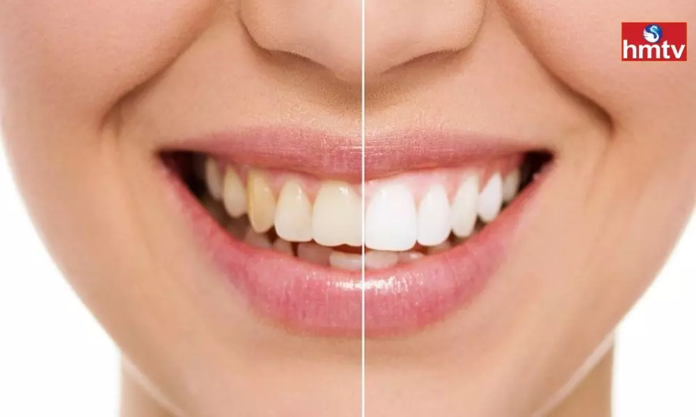 Have Your Teeth Turned Yellow Follow These Tips
